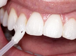 Preventive-Fluoride-Therapy